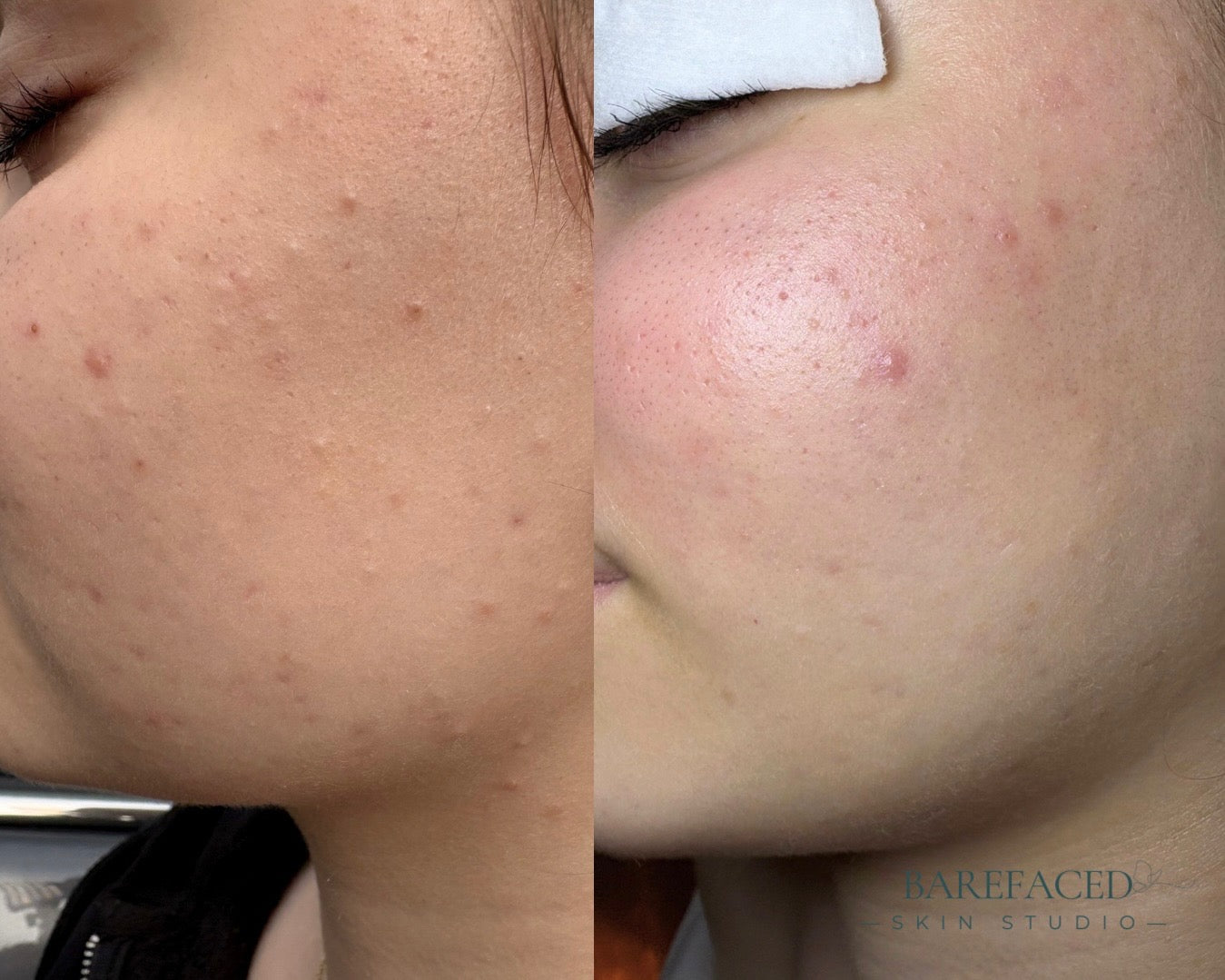 Why What Worked For Their Skin, Didn't Work For You