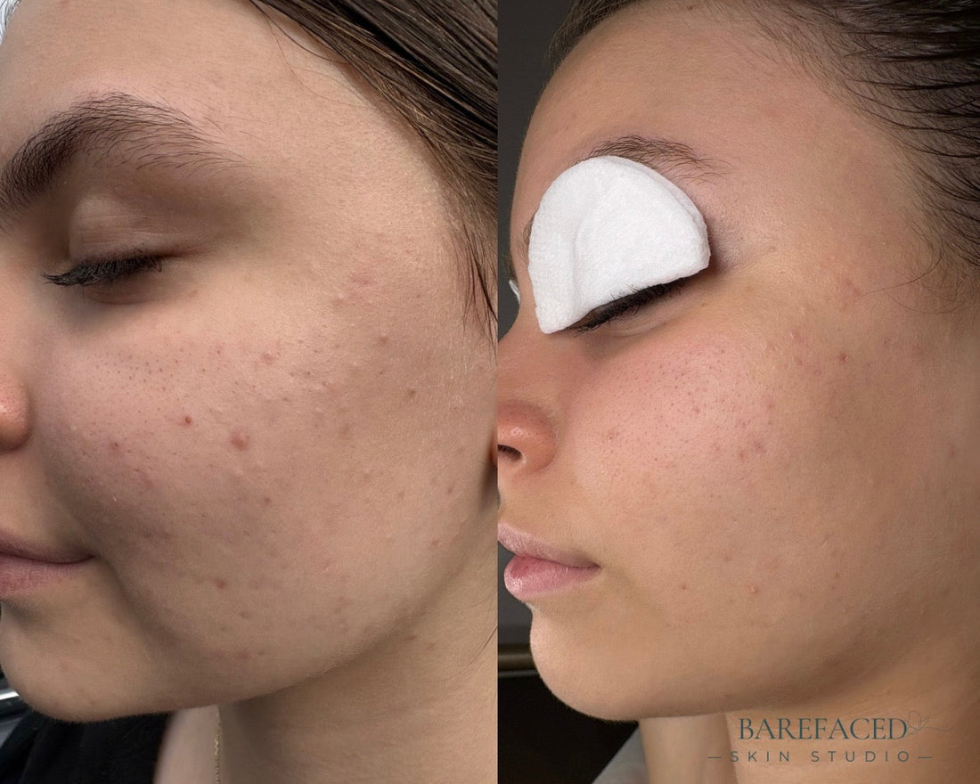 Why Do I Keep Breaking Out? Understanding How Acne Forms